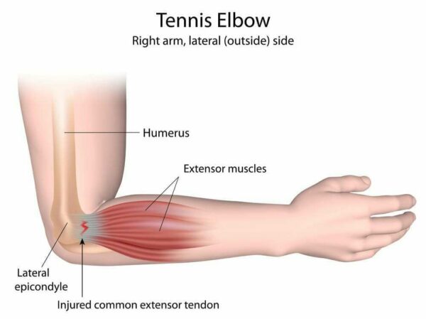 Trifocus Fitness Academy - elbow